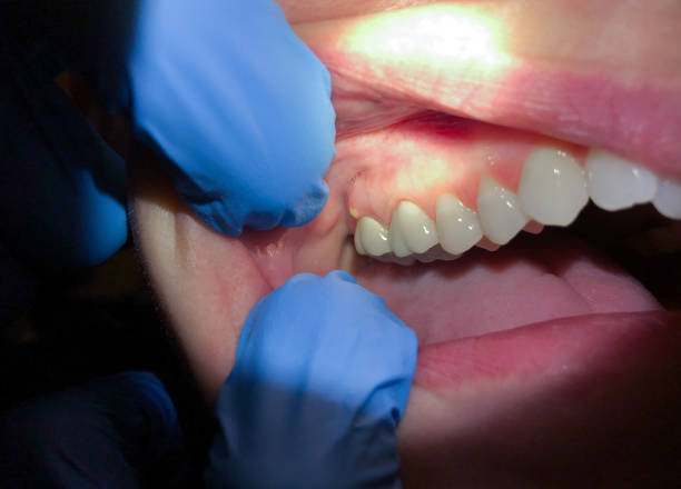 Best Dental Abscess Treatment in Panama, OK